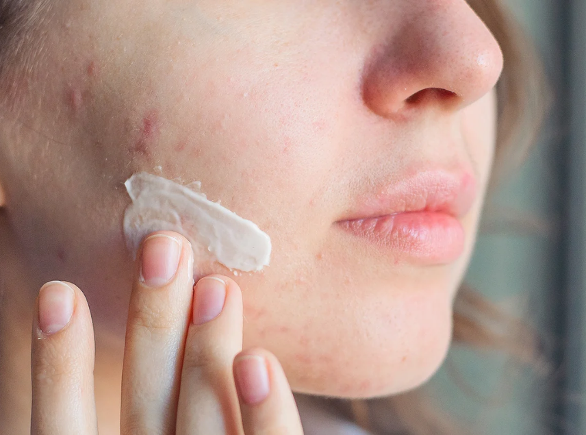 Norse Organics Acne